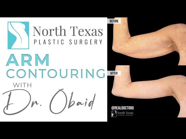 Arm Contouring