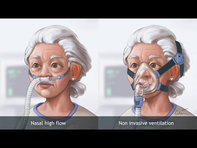 Nasal high‐flow therapy versus NIV in COPD patients with chronic respiratory failure