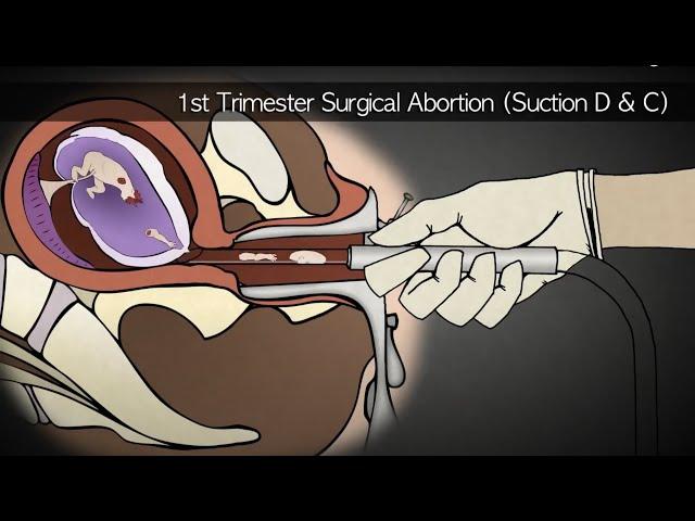 Abortion Procedures 1st, 2nd, and 3rd Trimesters