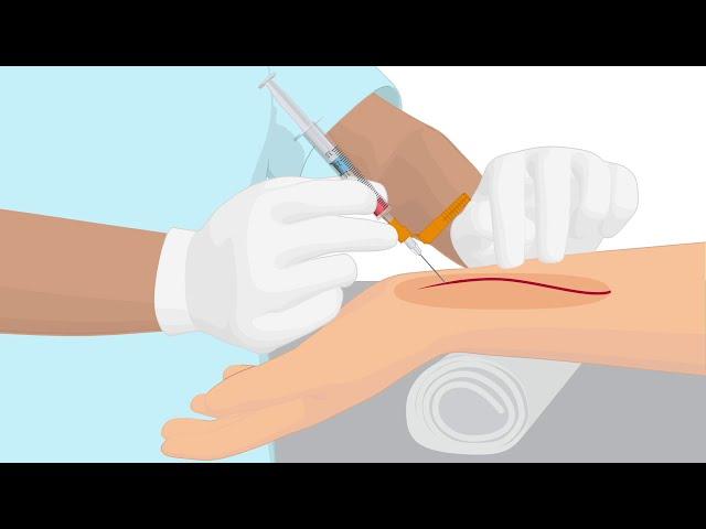 How to properly handle an arterial puncture blood gas sample