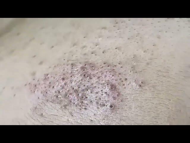 Blackhead Removal | 1 | Blackhead extraction | #blackheads