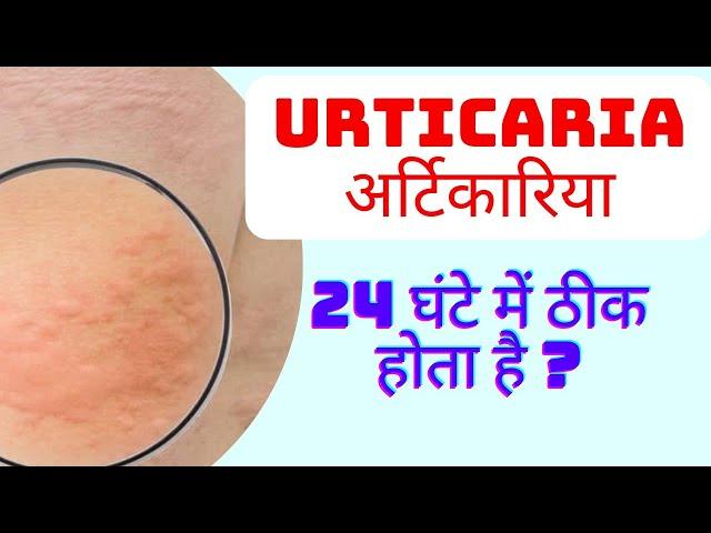 urticaria in hindi | urticaria treatment in hindi | hives on skin | urticaria symptoms