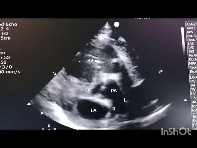 Transposition of great vessels on Echocardiography