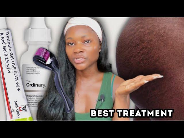 The best treatment for stretch marks ever! | How to clear stretch marks fast at home #stretchmarks