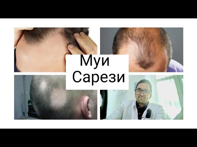 Сабабхои рехтани муи сар. Причины выпадения волос.