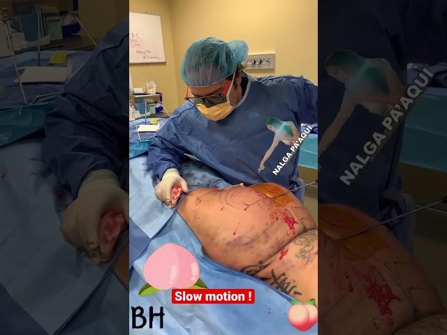 Brazilian butt lift in action ! | Dr Jeneby Slow motion bbl