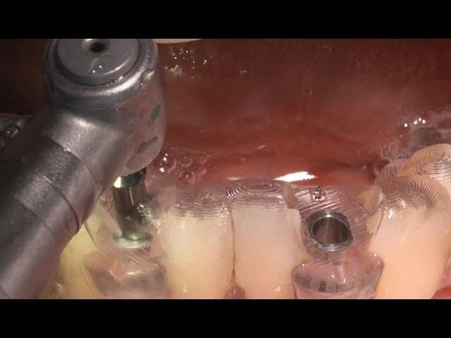 Simple & Easy immediate prosthesis using Dentium Digital Guide - Dr. Kang-Hee Lee