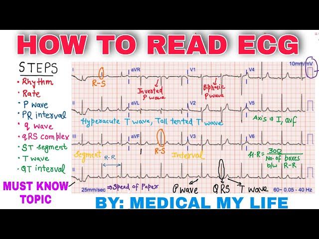 How To Read An ECG