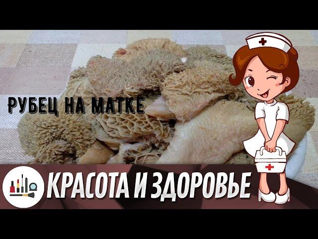 Рубец на матке