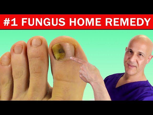 #1 Best Home Remedy Cure for Toenail Fungus!  Dr. Mandell