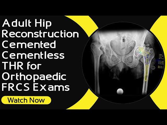 Adult Hip Reconstruction | Cemented / Cementless THR  for Orthopaedic FRCS Exams