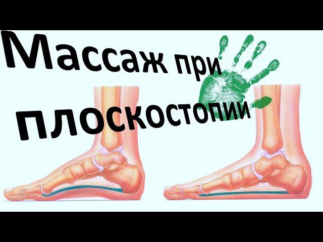 Массаж при плоскостопии у ребёнка