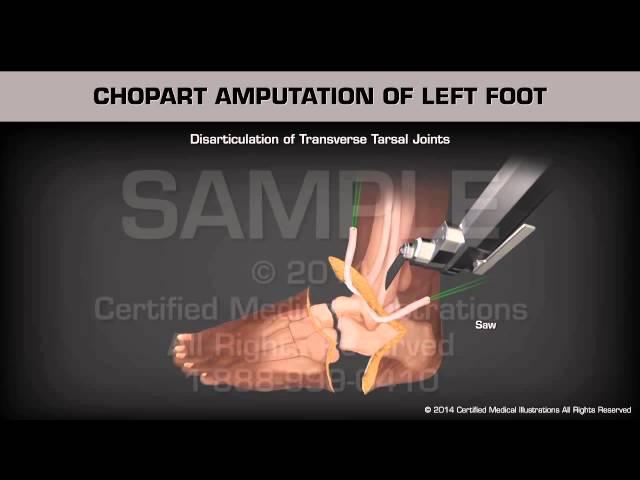 Ампутация левой стопы по Шопару