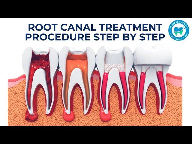 Root Canal Treatment (RCT) Procedure Step by Step | Animation Video | Dr.  Karuna Chaudhary