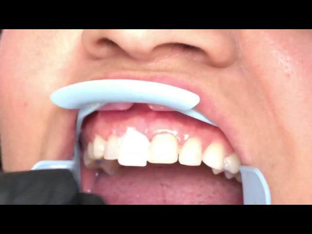 Houston Cosmetic Dentist...Lumineers ...Smile Transformation and Minimal Prep