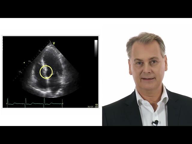 Case: Wall motion abnormality in an inferior infarct