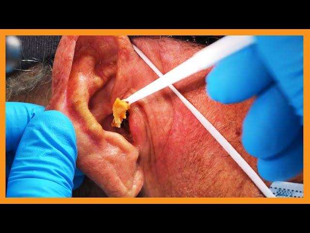 Ed's Earwax Extravaganza | Auburn Medical Group