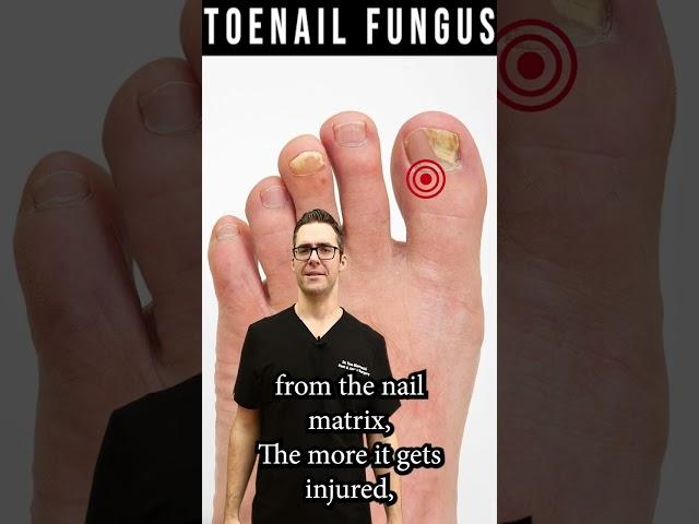 How to Know If Toenail Fungus is Dying? [How Fast Do Nails Grow?]