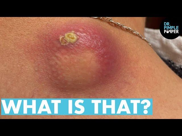 WHAT IS THAT! Dr Lee Pops Satisfying Back Cyst | Dr Pimple Popper Reacts