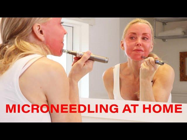 Microneedling DIY at Home - Tips, Warnings and Demo | Over 50