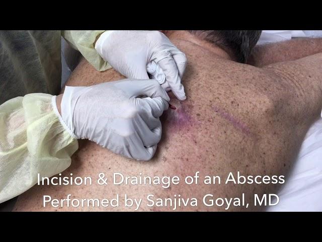 Incision and drainage of a large abscess on the back