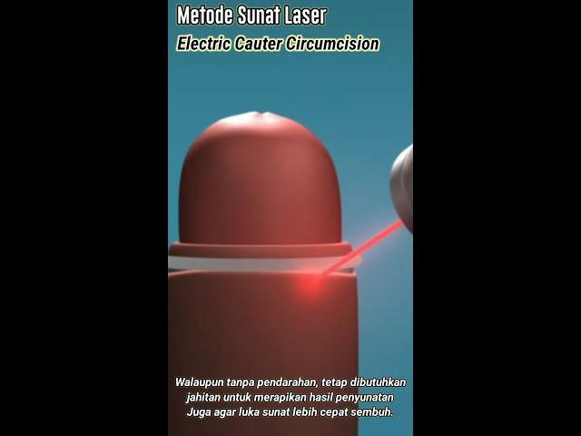 Animasi Sunat laser, Sakit tak berdarah metode Electric Cauter Circumcision