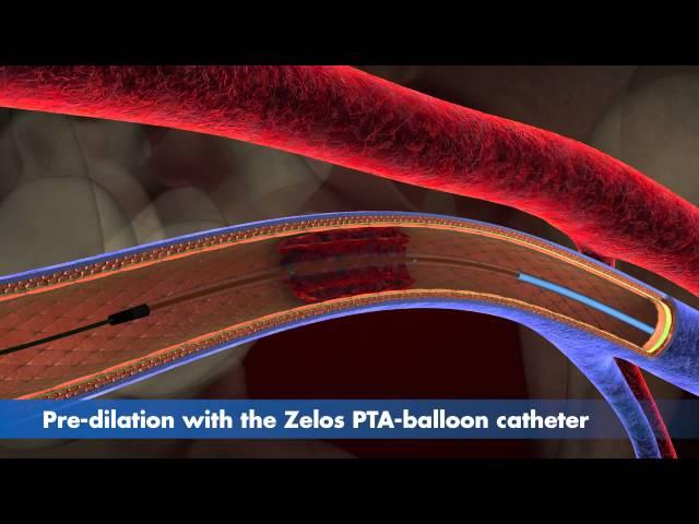 Stent Application sinus-Venous