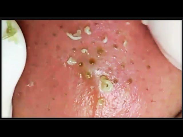 Relaxing With Top Skin #063 blackheads nose