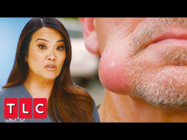 Squeezing Out a Swollen Jaw Lump! | Dr. Pimple Popper: A Pimple Carol