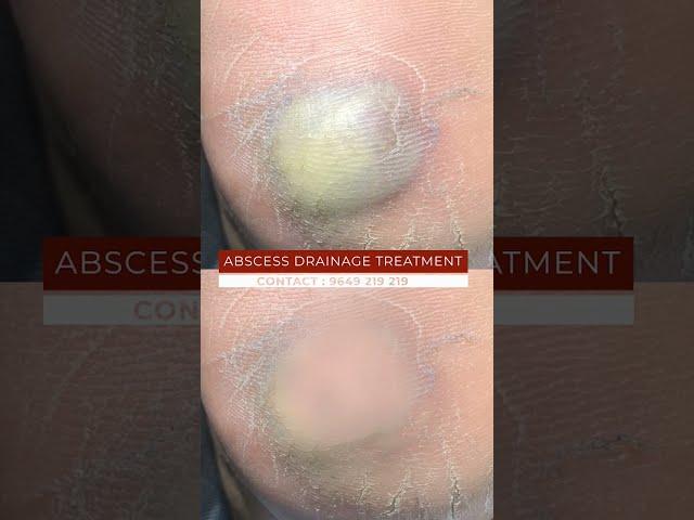 Think Abscess Drainage Treatment Is Too Good to Be True? We Have News for You | viral #shorts