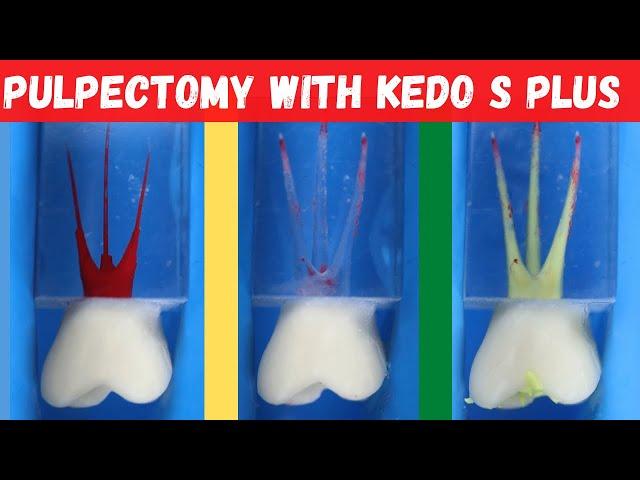 Pulpectomy Procedure with Kedo S Plus Files 🟡 Step By Step Demonstration