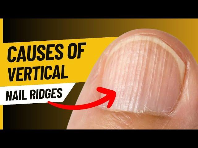 Causes of Vertical Ridges in Nails (9 Causes)