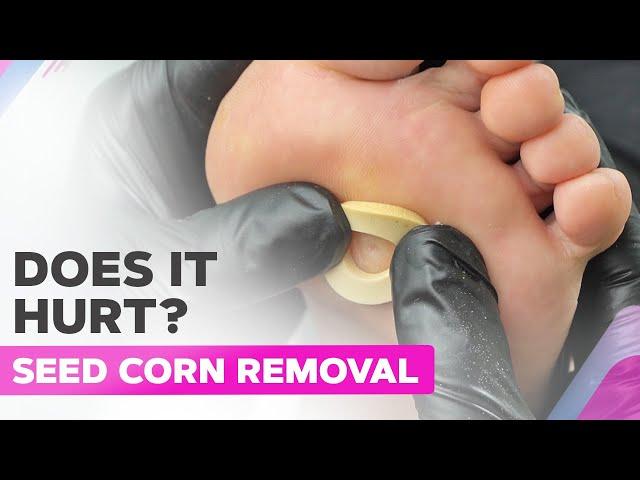 How To Remove a Seed Corn? Step-By-Step Guide