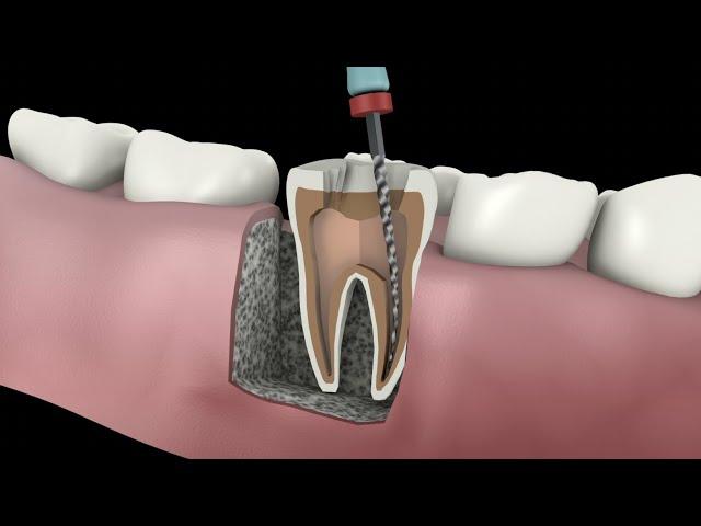 root canal procedure #shorts