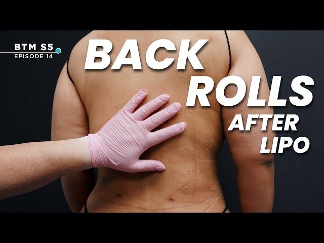 What Happens to Back Rolls After Liposuction?