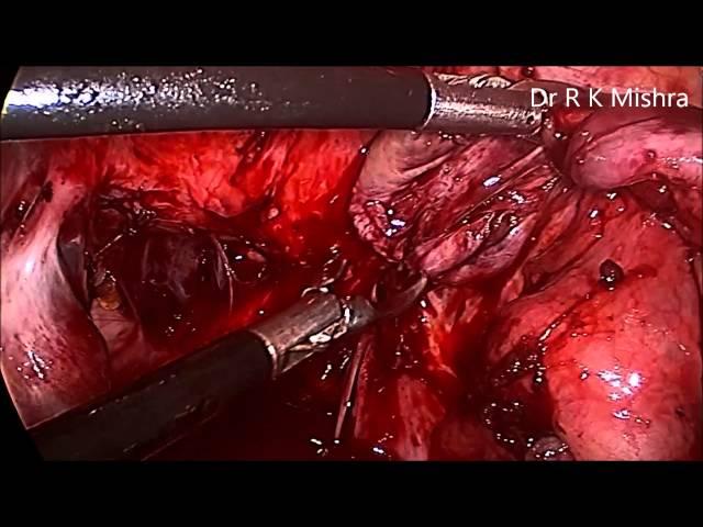 Laparoscopic Surgery for Endometriosis