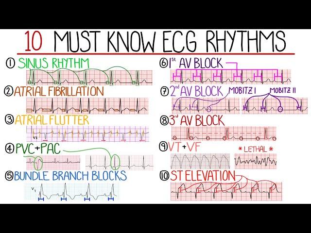 Most Common ECG Patterns You Should Know