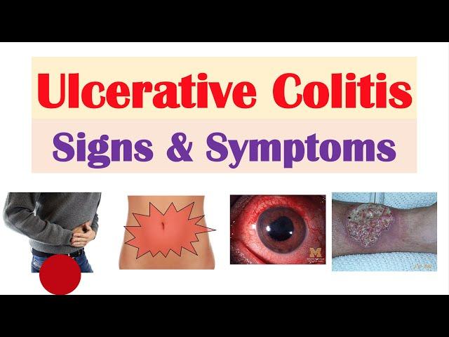 Ulcerative Colitis Signs and Symptoms (& Why They Occur), and Complications