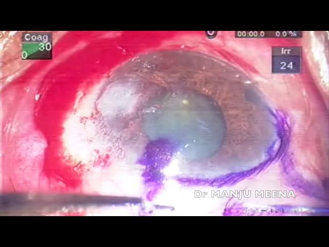 Pterygium removal with conjunctival autograft (Dr Manju Meena)