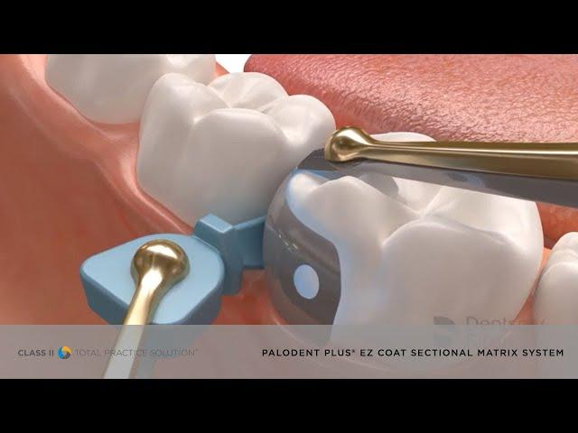 Palodent® Plus EZ Coat System – Sectional Matrix System | Dentsply Sirona