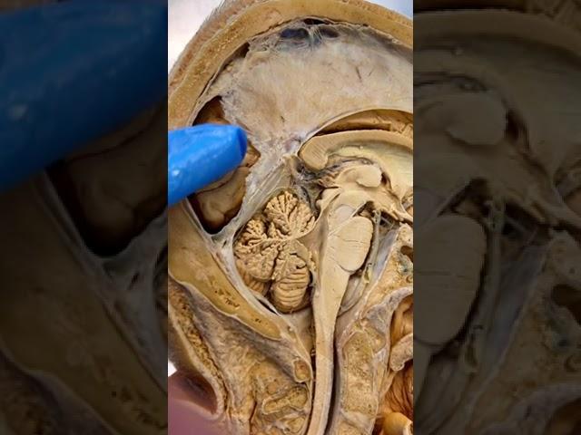 This Is What Connects Both Sides of Your Brain | The Corpus Callosum