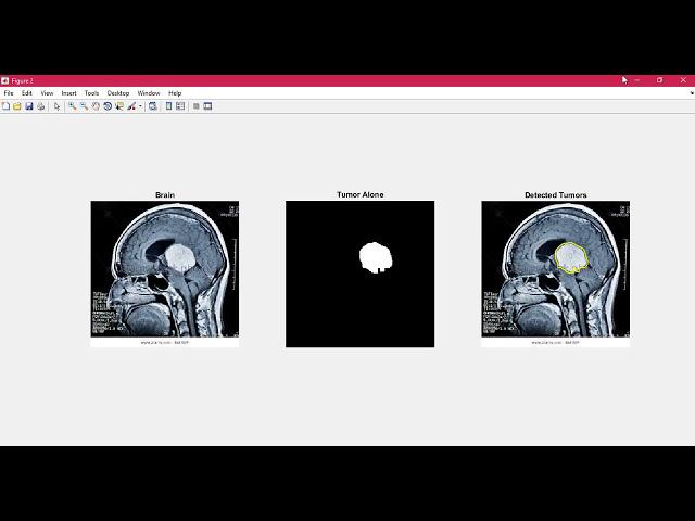 Brain Tumor Detection using Matlab - Image Processing + GUI step by step