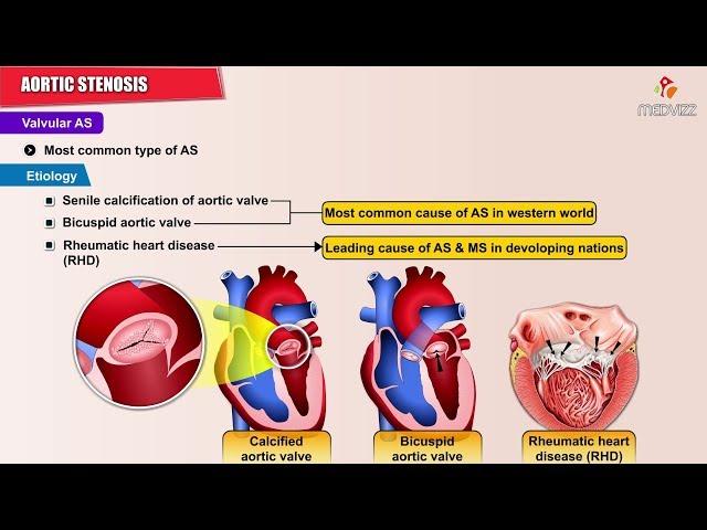 Aortic Stenosis  - Causes , Symptoms , Pathology , Diagnosis and Treatment