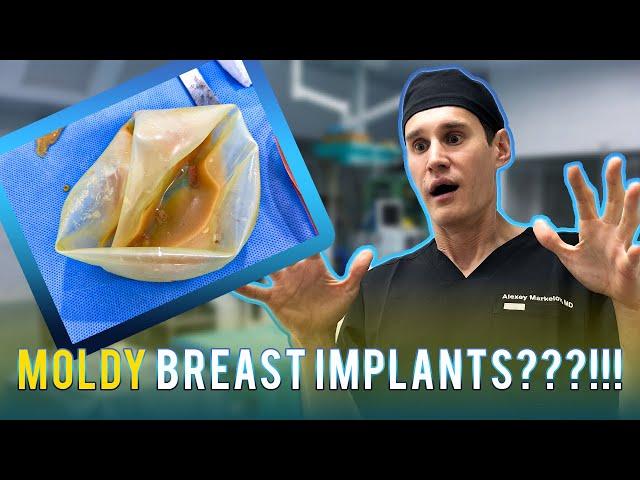 Forever Love? Unveiling the Truth about Breast Implants Removal