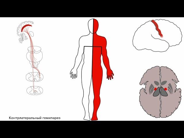 Пирамидный путь (кортико-спинальный, корково-спинномозговой). Центральный парез.