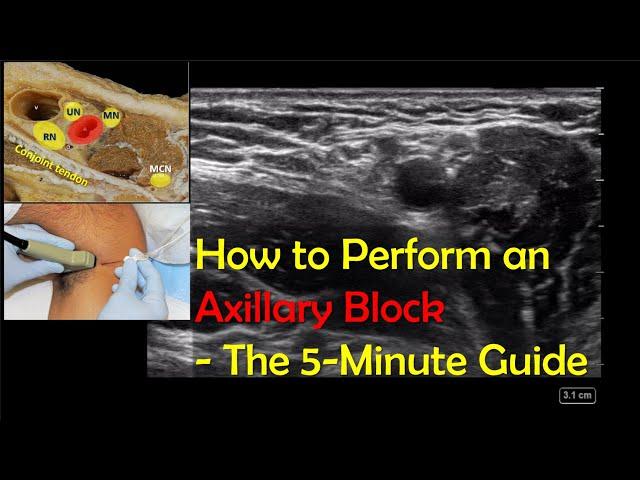 Axillary Block – A "How-To" Guide