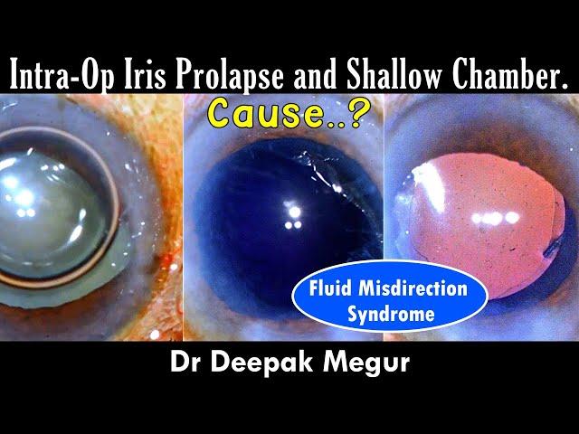 Intra-Op Iris Prolapse and Shallow Chamber ...Cause..? - Dr Deepak Megur