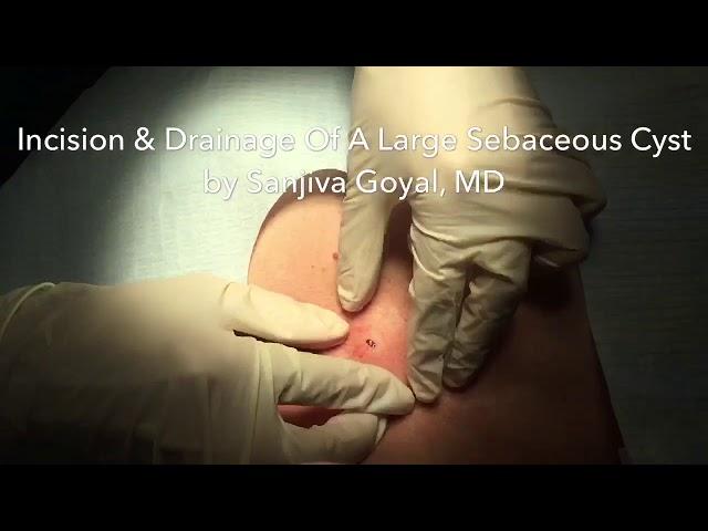 Incision & Drainage of a Large Sebaceous Cyst