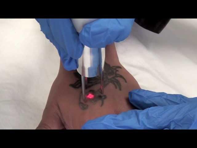 Q-Switched Nd:YAG Tattoo Removal Laser -- The Astanza Duality