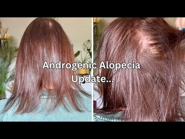 Experiencing Increased Hair Shedding With Minoxidil Treatment | Androgenic Alopecia Update